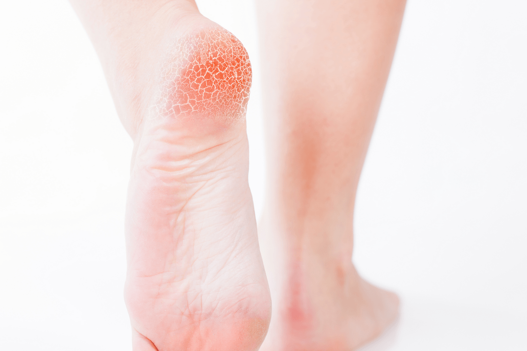 θεραπεία του μύκητα των ποδιών σε πρώιμο στάδιο