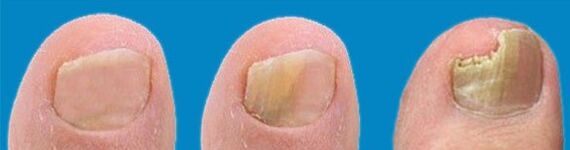 Διαδικασία ανάπτυξης μυκήτων