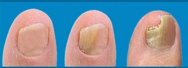 διαδικασία ανάπτυξης μυκήτων